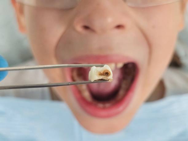 Best Urgent Tooth Repair  in Cameron, WI